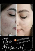 لوسیون ضدجوش و کنترل کننده چربی صورت